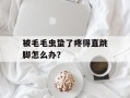 被毛毛虫蛰了疼得直跳脚怎么办？
